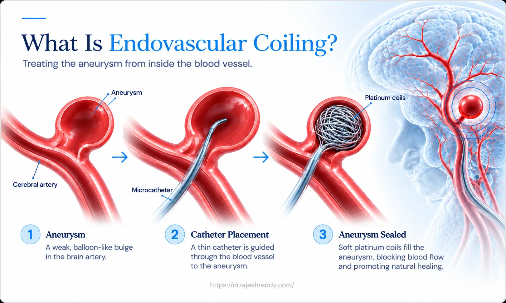 What Is Endovascular Coiling for Brain Aneurysm